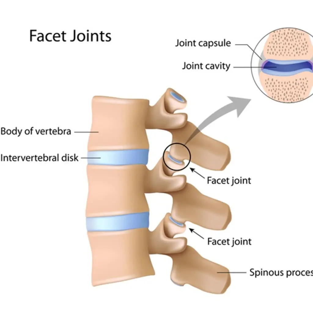 Facet Joint Arthropathy