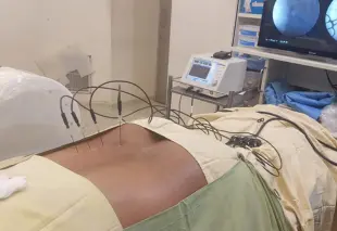 Radiofrequency Ablation (RFA)