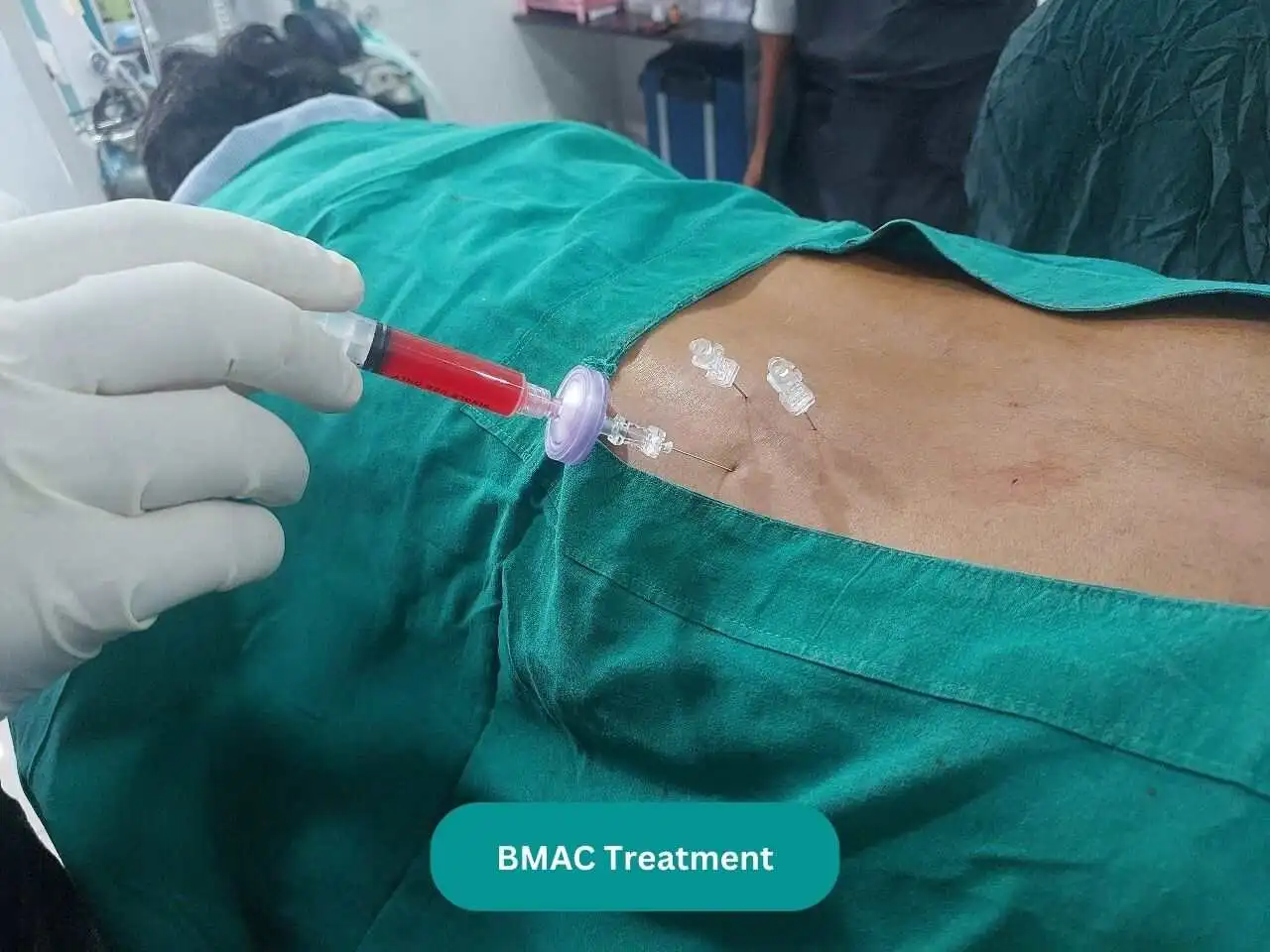 BMAC Treatment