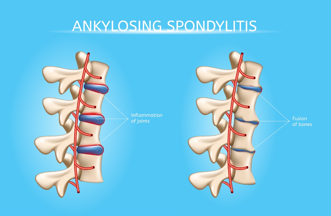 Ankylosing spondylitis, infection, tumors