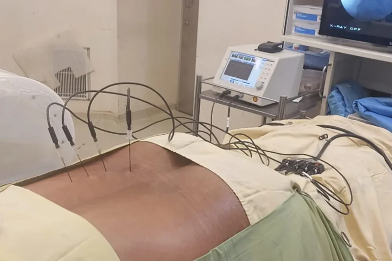 Radiofrequency